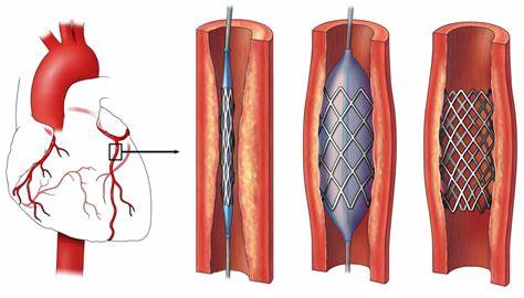 Lining medical stents with hairlike fuzz could fend off infections