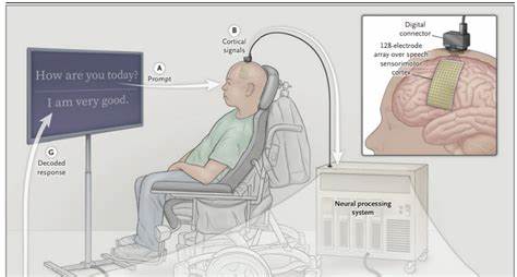 Brain-computer interface restores natural speech after paralysis