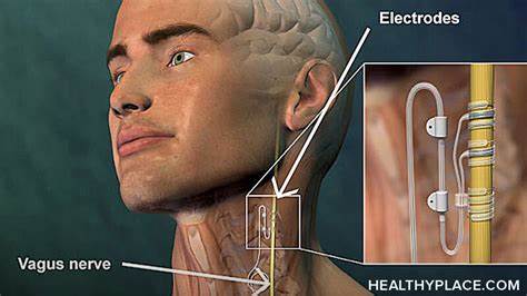 Vagus nerve stimulation therapy for treatment-resistant PTSD