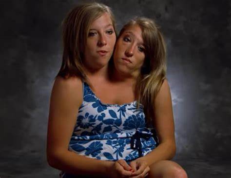 Can Abby Hensel’s Conjoined Twin Feel Her Sister’s Orgasms and Intimate Moments? An Expert Explains - Yahoo Entertainment
