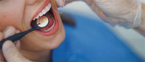 Two cities stopped adding fluoride to water. Science reveals what happened